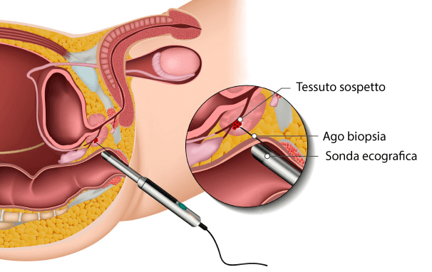 Biopsia della prostata Thiene Poliambulatori San Gaetano