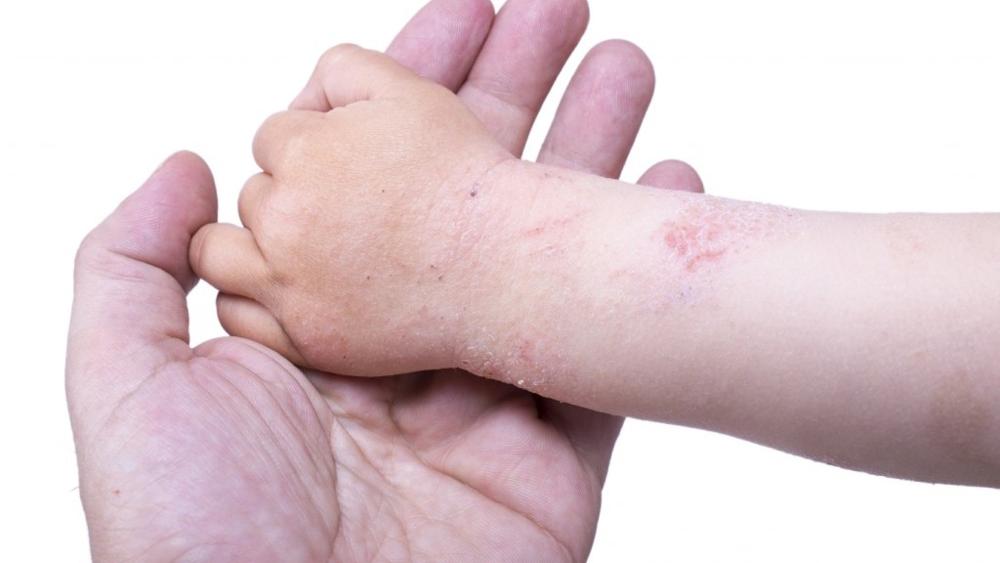 Dermatite atopica nei bambini: una malattia da non sottovalutare
