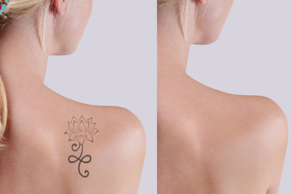 La rimozione del tatuaggio mediante laser terapia