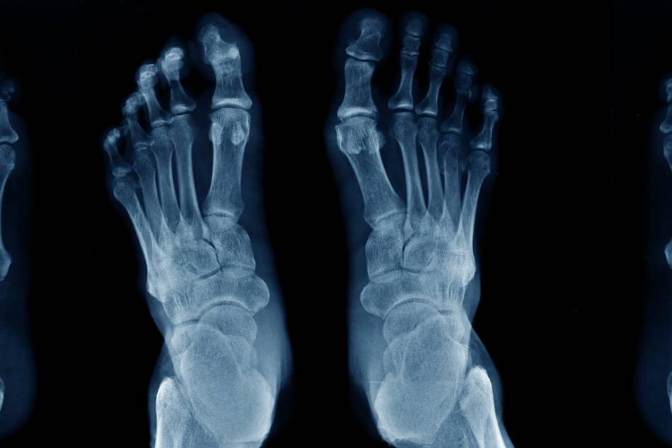 radiografia rx piedi thiene vicenza