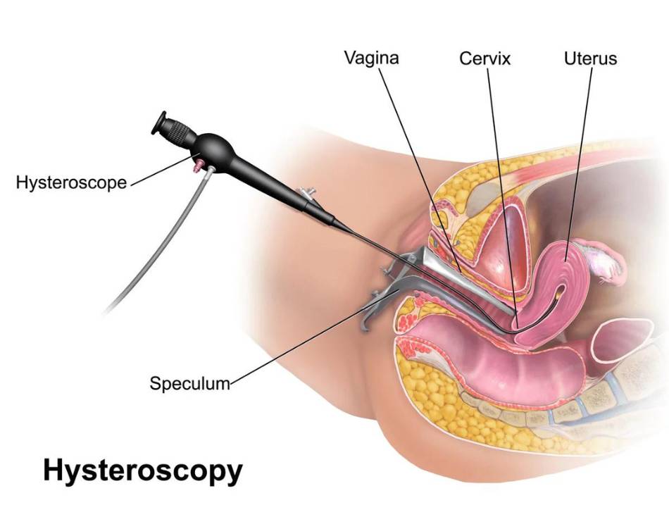 Isteroscopia biopsia utero thiene schio vicenza- Poliambulatori San Gaetano