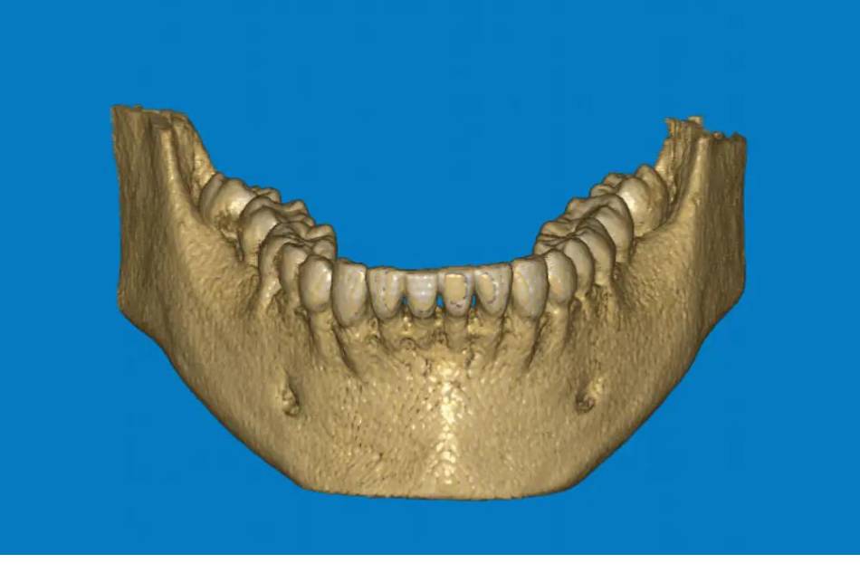 Tac dentale 3D