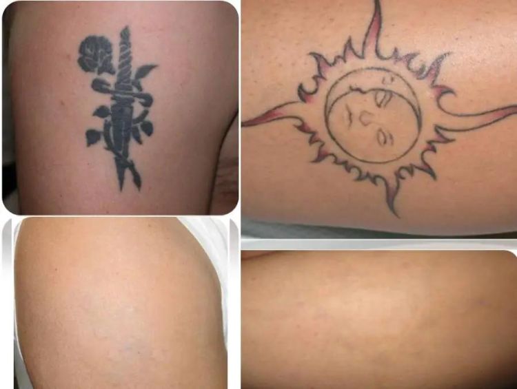 prima e dopo rimozione tatuaggi medicina estetica thiene