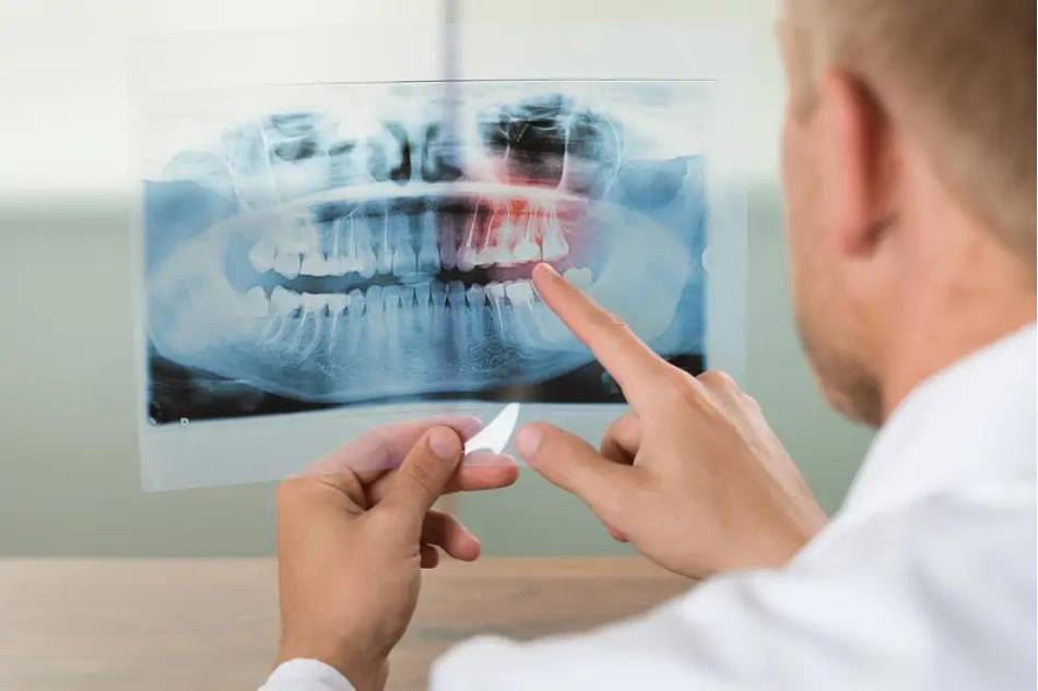 Panoramica dentale: di cosa si tratta? In quali casi è utile?