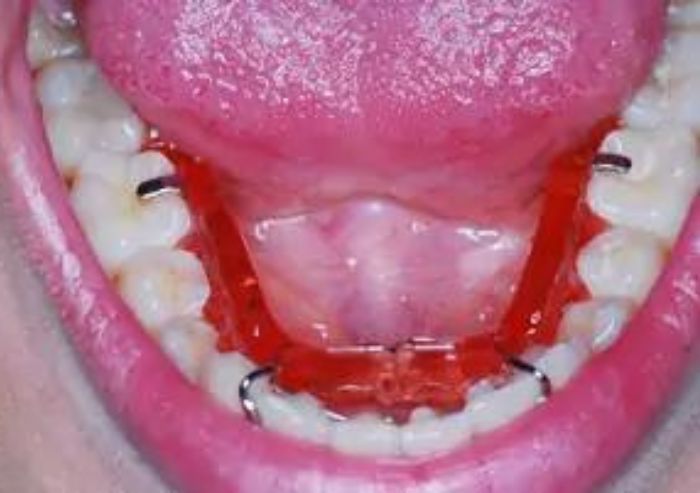 apparecchio denti thiene 2