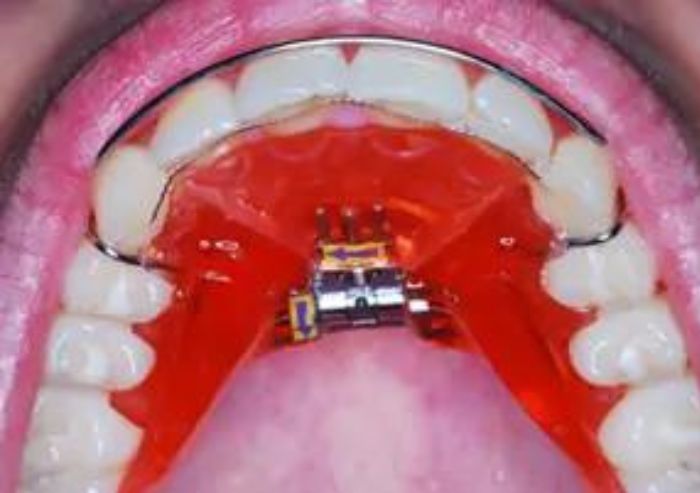 apparecchio per denti thiene