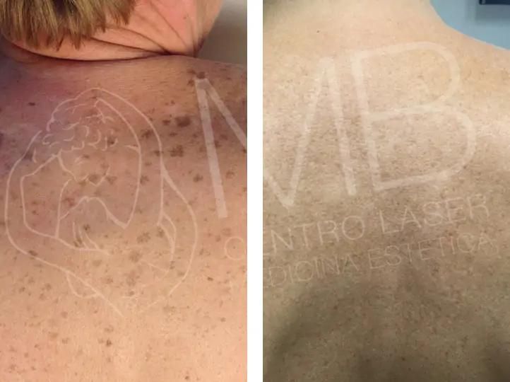 trattamento laser Macchie della pelle vicenza