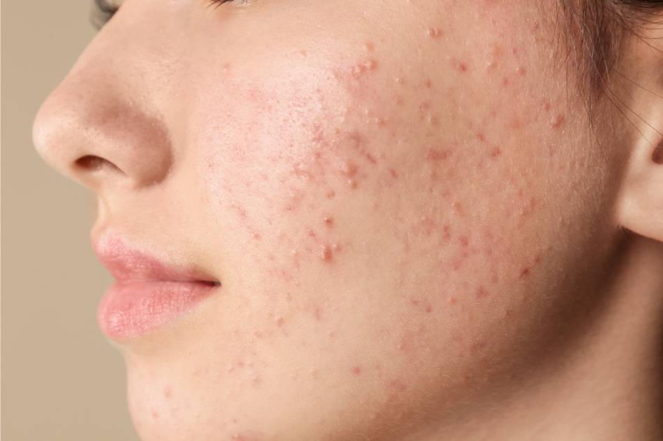 Quali sono le ripercussioni psicologiche dell’acne