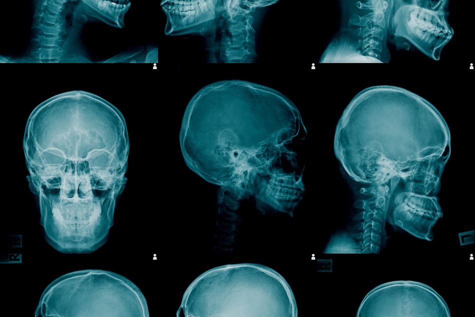 Teleradiografia del Cranio thiene schio vicenza