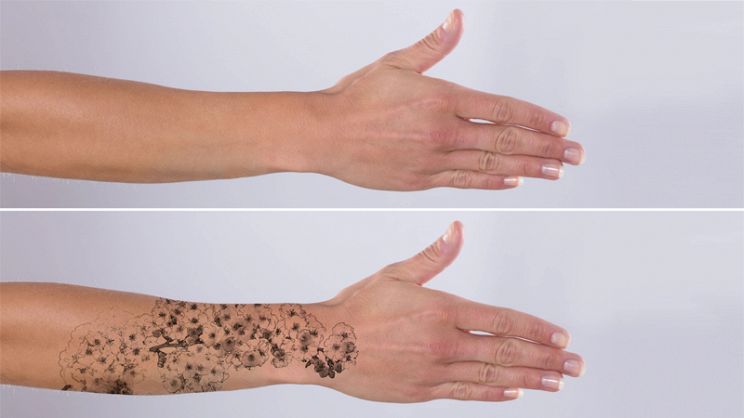 Rimozione tatuaggi: quando e dove effettuare il trattamento?