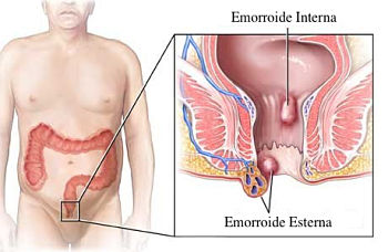 emmorroidi sintomi