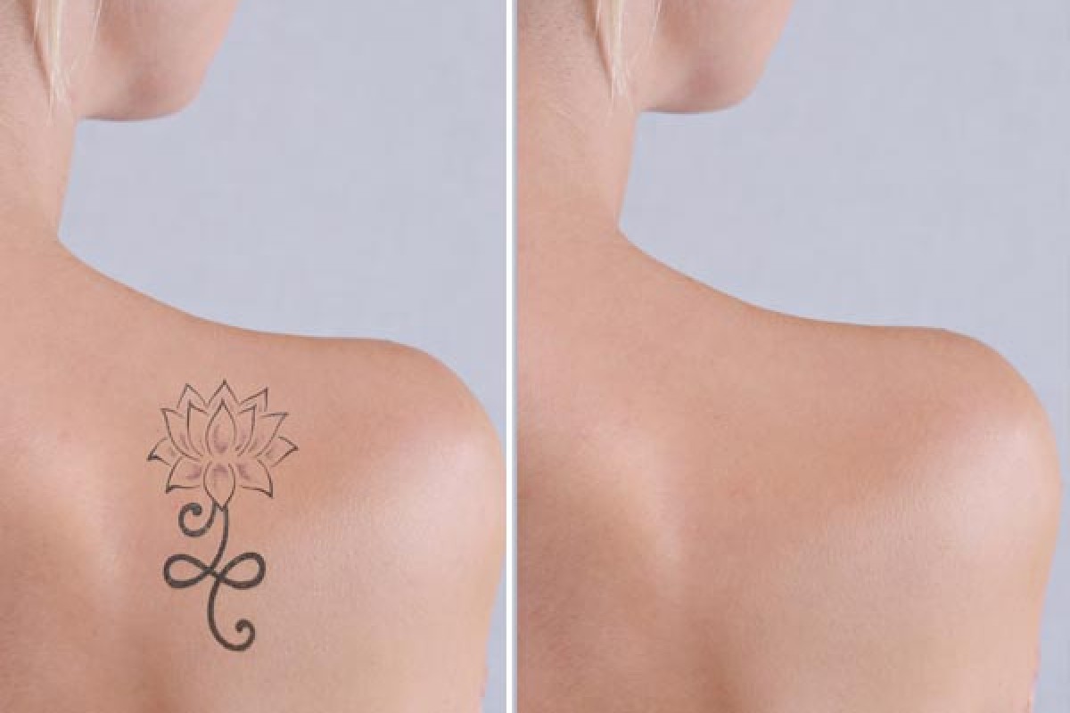 Rimuovere i tatuaggi in modo sicuro ed efficace con Picolaser Q-Switched