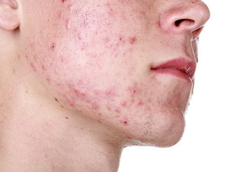 Anche l’acne acuta può essere curata senza farmaci