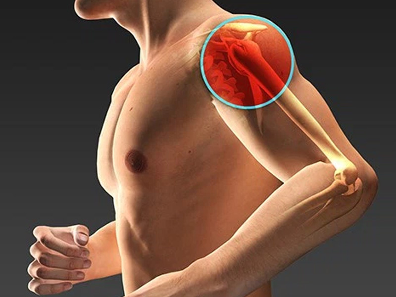 Dolore alla spalla: l’artroscopia per la lesione della cuffia dei rotatori