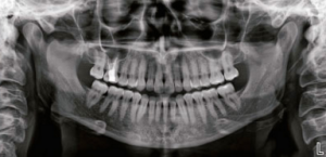 Cos’è e a cosa serve la Panoramica Dentale (OPT)